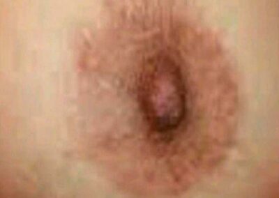 Cicatrice Areola Mammaria Seno Dopo. Dermopigmentazione Paramedicale Rosy Di Dato Dermopigmentista