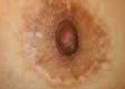 Cicatrice Areola Mammaria Seno Prima. Dermopigmentazione Paramedicale Rosy Di Dato Dermopigmentista