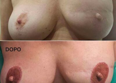 Dermopigmentazione paramedicale seno destro prima e dopo il trattamento | TRICODERMSOLUTIONS