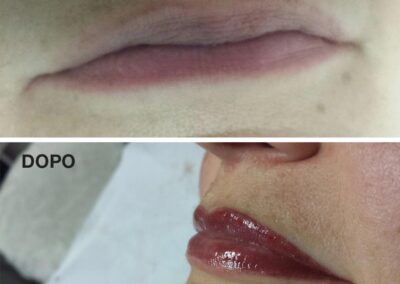 Dermopigmentazione estetica labrra prima e dopo il trattamento | TRICODERMSOLUTIONS