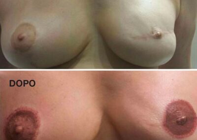 Dermopigmentazione Paramedicale seno | TRICODERMSOLUTIONS