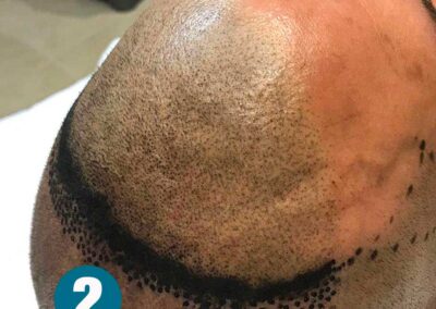 Esecuzione trattamente Tricopigmentazione Uomo | TRICODERMSOLUTIONS