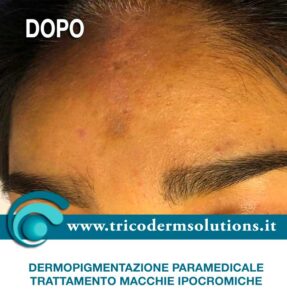 Dermopigmentazione Paramedicale - DOPO Trattamento macchia ipocromica su base genetica.