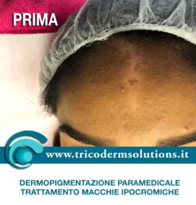 MACCHIA IPOCROMICA - Trattamento di Dermopigmentazione Paramedicale