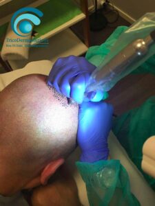 La Tricopigmentazione: una valida soluzione per la calvizie. | TRICODERMSOLUTIONS