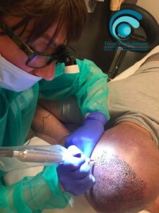 Trattamento di Tricopigmentazione | TRICODERMSOLUTIONS