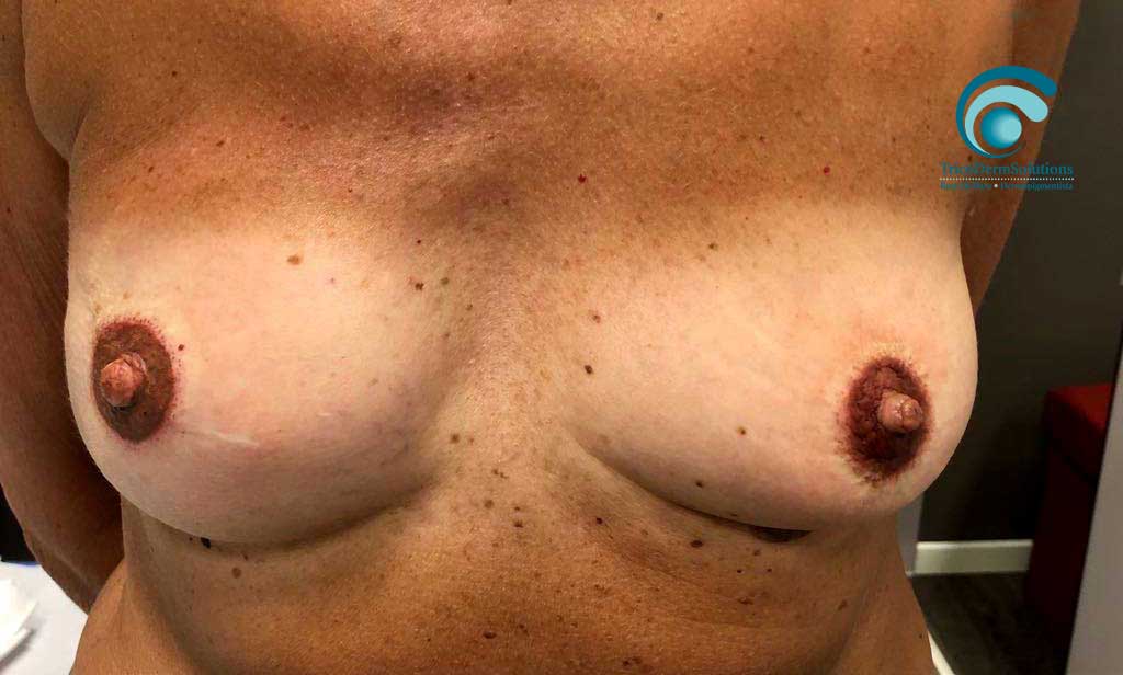 seno dopo trattamento dermopigmentazione