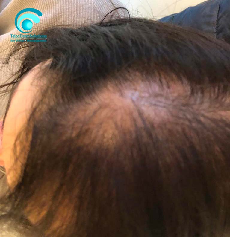 Alopecia Donna Prima Tricopigmentazione | TRICODERMSOLUTIONS