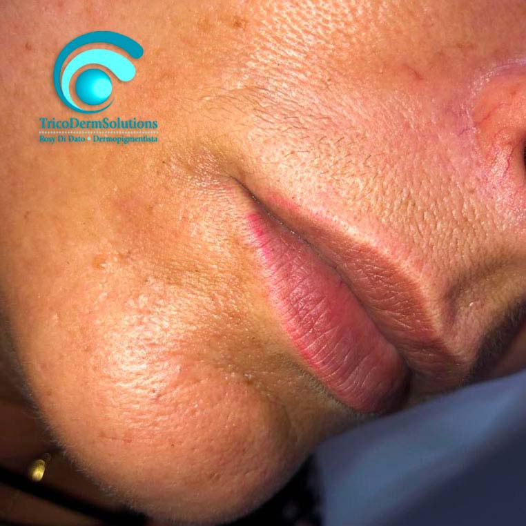 Labbra prima del Trattamento di Dermopigmentazione | TRICODERMSOLUTIONS