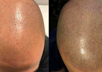 Tricopigmentazione effetto rasato prima e dopo il trattamento | TRICODERMSOLUTIONS