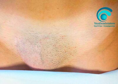 Pube con viligine unilaterale dopo il primo trattamento di dermopigmentazione tricopigmentazione | TRICODERMSOLUTIONS