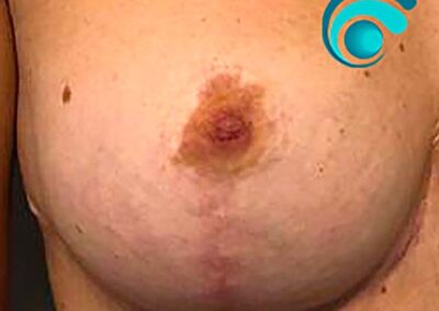 Areola Mammaria destra Post Intervento di Mastopessi (prima del trattamento) | TRICODERMSOLUTIONS