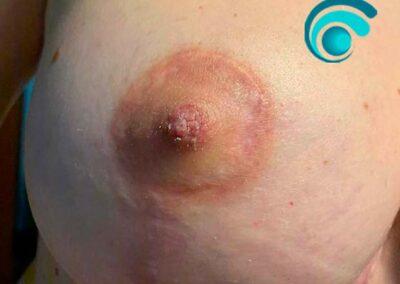 Areola Mammaria destra Post Intervento di Mastopessi (dopo il trattamento) | TRICODERMSOLUTIONS