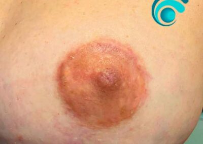 Dermopigmentazione Areola Mammaria sinistra Post Intervento di Mastopessi (dopo il trattamento) | TRICODERMSOLUTIONS