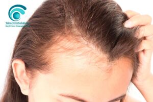 Trattamento Carbossiterapia per Diradamento Capelli Donna | TRICODERMSOLUTIONS