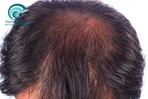 Trattamento Carbossiterapia per Diradamento Capelli Uomo | TRICODERMSOLUTIONS
