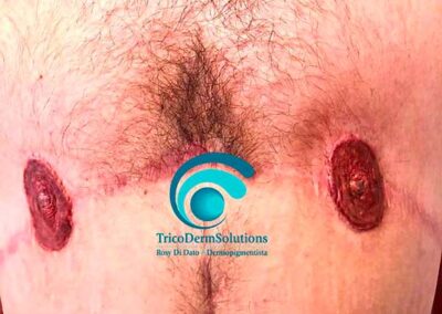 Definizione areola capezzolo uomo post intervento chirurgico estetico di ifting cutaneo | TRICODERMSOLUTIONS