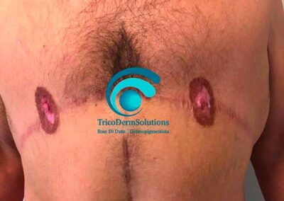 Prima del trattamento di dermopigmentazione paramedicale per la definizione del complesso areola capezzolo uomo | TRICODERMSOLUTIONS