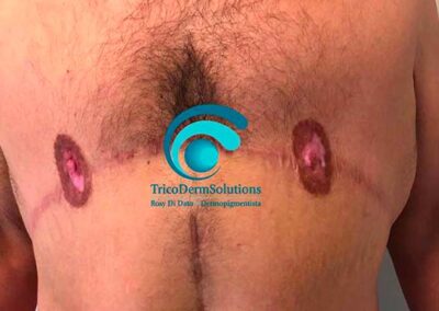 Prima del trattamento di dermopigmentazione paramedicale per la definizione del complesso areola capezzolo uomo | TRICODERMSOLUTIONS