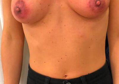 Vitiligine Seno Complesso Areola Capezzolo Parma