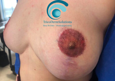 Dermopigmentazione Paramedicaele al seno dopo un intervento Estetico di Mastopessi | TRICODERMSOLUTIONS