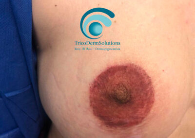 Dermopigmentazione Paramedicale Seno Destro dopo un intervento Estetico di Mastopessi | TRICODERMSOLUTIONS