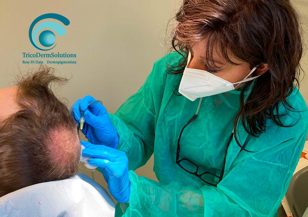 Infermiera in medicina estetica: un nuovo traguardo - Intervento di Carbossiterapia come Soluzione al Diradamento Capelli | TRICODERMSOLUTIONS