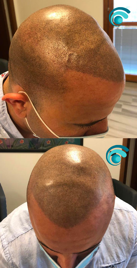 Tatuaggio dei capelli con la tricopigmentazione per simulare effetto rasato in caso di alopecia o calvizie | TRICODERMSOLUTIONS