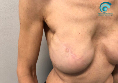 Complesso Areola Capezzolo Post Mastectomia Demolitiva prima del Trattamento di Dermopigmentazione | TRICODERMSOLUTIONS