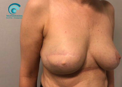 Complesso Areola Capezzolo Post Mastectomia prima del Trattamento di Dermopigmentazione Paramedicale | TRICODERMSOLUTIONS