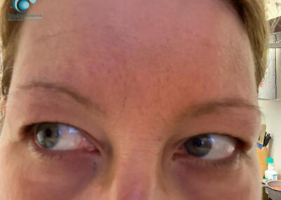 Dermopigmentazione Estetica Semipermanente: Sopracciglia Prima | TRICODERMSOLUTIONS