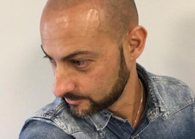 Effetto Rasato, Fase Intermedia, Dermopigmentazione Capelli | TRICODERMSOLUTIONS