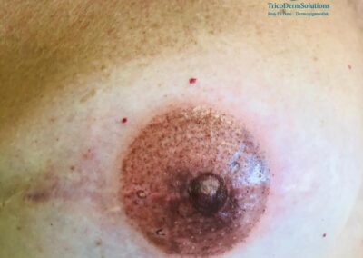 Complesso Areola Mammaria Dopo Trattamento di Dermopigmentazione, Milano | TRICODERMSOLUTIONS