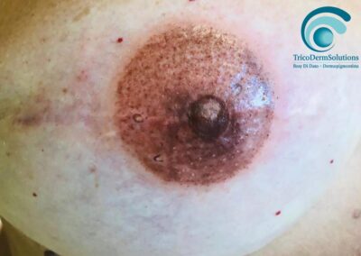 Dermopigmentazione Areola Mammaria in 3D Post Intervento Oncologico – Milano