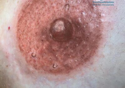 Dermopigmentazione Areola Mammaria Milano | TRICODERMSOLUTIONS