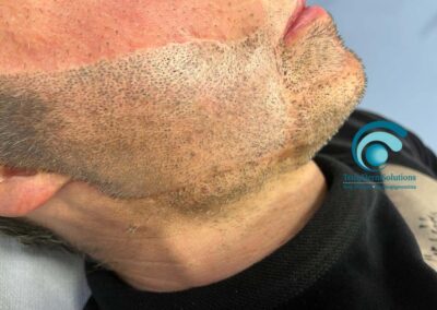 Tricopigmentazione Barba Prima del trattamento | TRICODERMSOLUTIONS