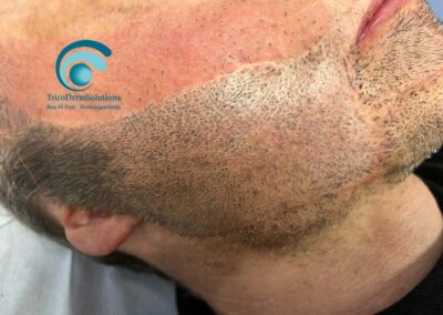 Tricopigmentazione Barba | TRICODERMSOLUTIONS