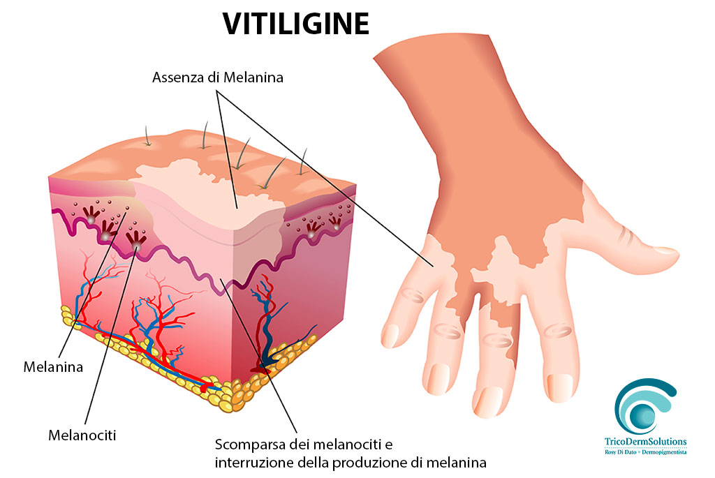 Vitiligine: le Caratteristiche dei Pazienti | TRICODERMSOLUTIONS