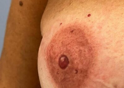 Complesso Areola Mammaria Dopo il trattamento di dermopigmentazione | TRICODERMSOLUTIONS