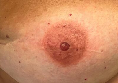 Areola mammaria durante il trattamento di dermopigmentazione paramedicale | TRICODERMSOLUTIONS