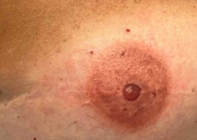 Dettaglio Areola mammaria durante il trattamento di dermopigmentazione | TRICODERMSOLUTIONS